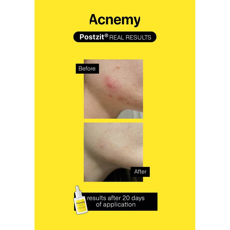 Serum pentru semne post-acneice cu Aha si Bha, Postzit, 30ml, Acnemy