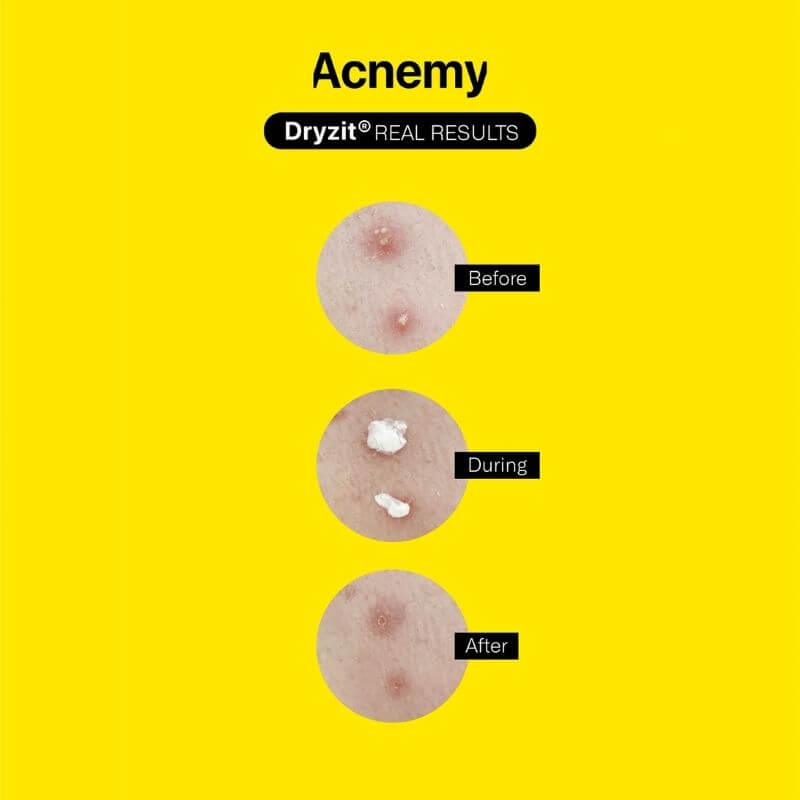Lotiune pentru uscarea cosurilor cu Acid Salicilic, Dryzit, 30ml, Acnemy